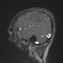 Cerebral venous infarction - hemorrhagic (Radiopaedia 81625-95505 Sagittal MRV 17).jpg