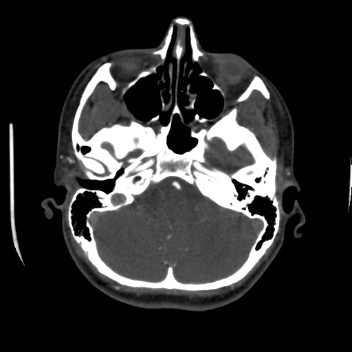 Cerebral venous sinus thrombosis (Radiopaedia 40619-43227 A 48).jpg