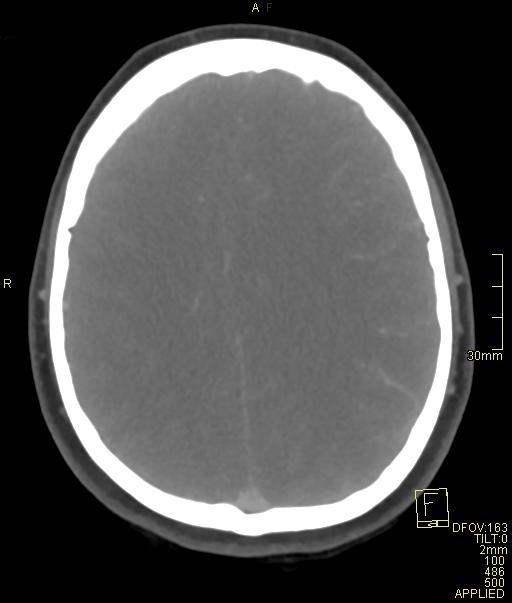 Cerebral venous sinus thrombosis (Radiopaedia 91329-108965 Axial venogram 56).jpg