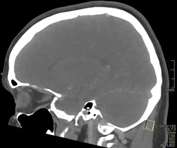 Cerebral venous sinus thrombosis (Radiopaedia 91329-108965 Sagittal venogram 28).jpg