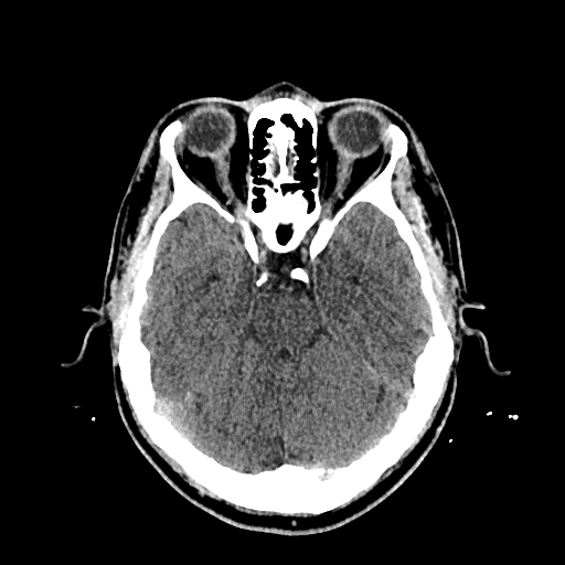 File:Cerebral venous thrombosis (CVT) (Radiopaedia 77524-89685 Axial non-contrast 16).jpg