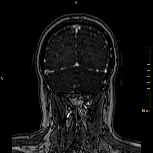 Cerebral venous thrombosis (Radiopaedia 23288-23351 MRV 145).JPG