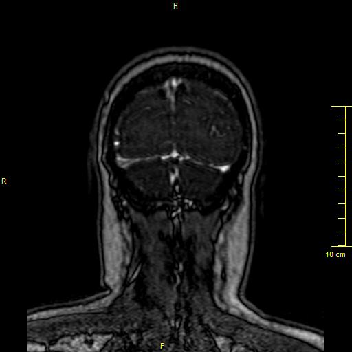 File:Cerebral venous thrombosis (Radiopaedia 23288-23351 MRV 160).JPG