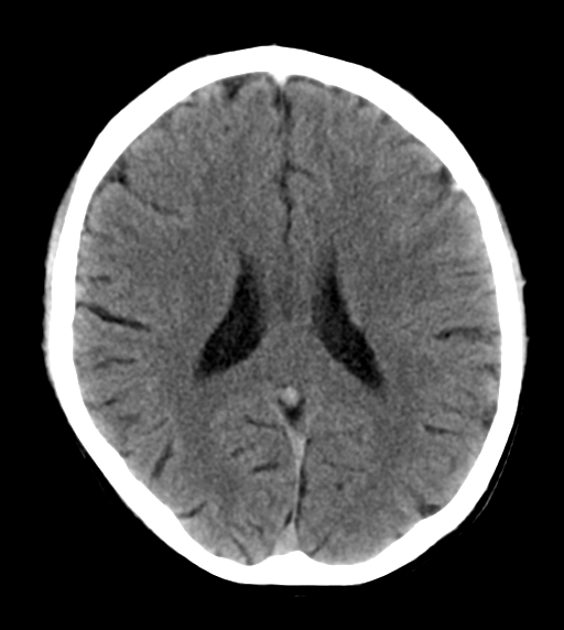 File:Cerebral venous thrombosis (Radiopaedia 38392-40467 Axial non-contrast 17).png