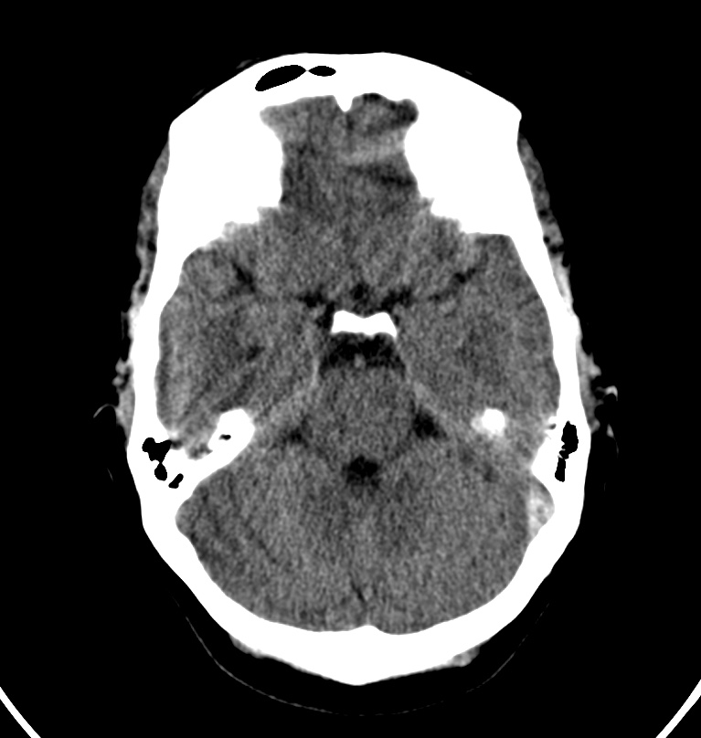 Cerebral venous thrombosis - CT only (Radiopaedia 41031-43778 Axial non-contrast 59).jpg