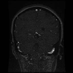 Cerebral venous thrombosis - ulcerative colitis (Radiopaedia 66049-75219 Coronal MRV 43).jpg