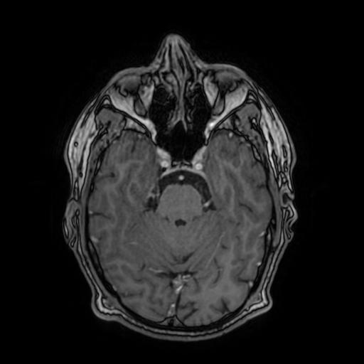 File:Cerebral venous thrombosis with secondary intracranial hypertension (Radiopaedia 89842-106957 Axial T1 C+ 68).jpg