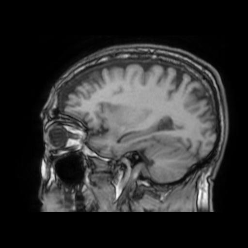File:Cerebral venous thrombosis with secondary intracranial hypertension (Radiopaedia 89842-106957 Sagittal T1 10).jpg