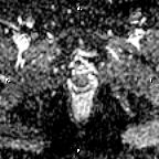 File:Cervical adenocarcinoma (Radiopaedia 65011-73985 Axial ADC 7).jpg