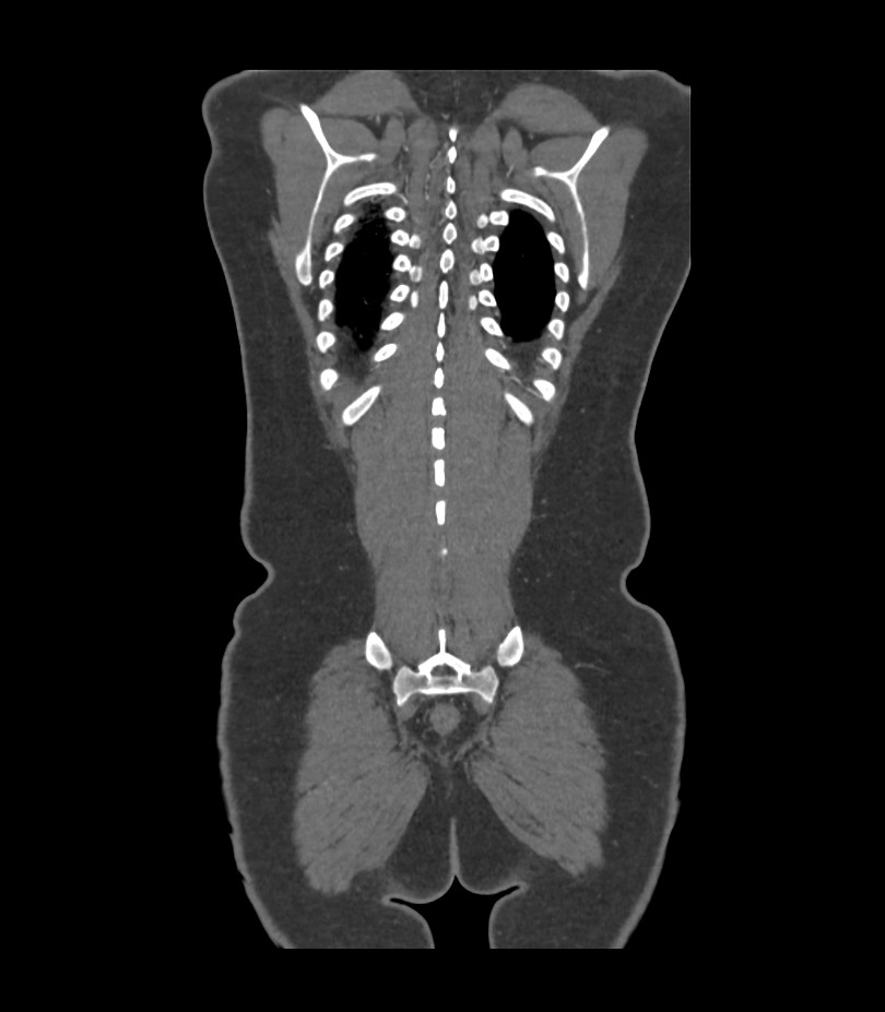 Cervical aortic arch with coarctation and aneurysms (Radiopaedia 44035-47552 C 4).jpg