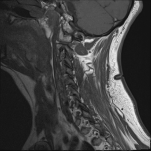 File:Cervical canal stenosis due to ossification of the posterior longitudinal ligament (Radiopaedia 47260-51824 Sagittal T1 2).png