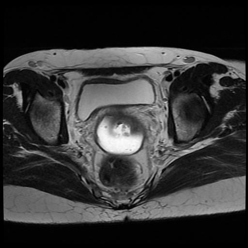 File:Cervical cancer (Radiopaedia 62991-71413 Axial T2 11).jpg