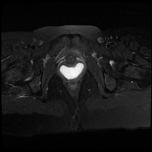 File:Cervical cancer (Radiopaedia 62991-71413 Axial T2 fat sat 16).jpg
