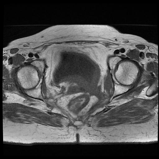 File:Cervical carcinoma (Radiopaedia 70924-81132 Axial T1 11).jpg