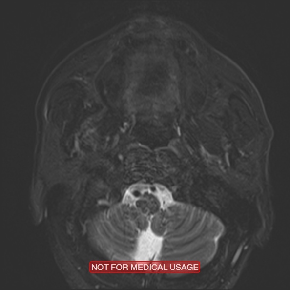 Cervical nerve schwannoma (Radiopaedia 27964-28221 C 18).jpg