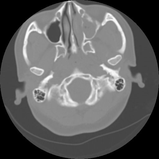 Cervical rib (Radiopaedia 71110-81363 Axial non-contrast 12).jpg