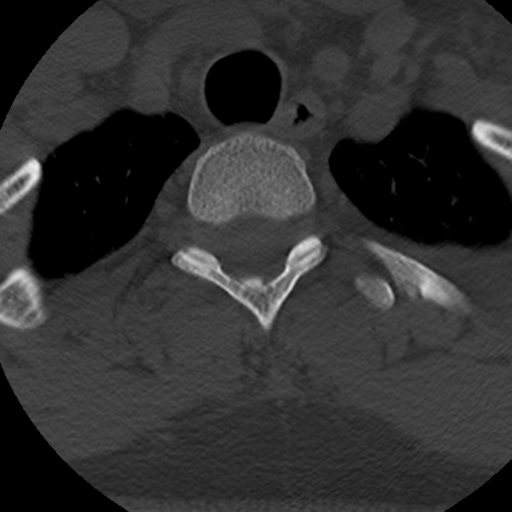 File:Cervical schwannoma (Radiopaedia 57979-64974 Axial bone window 47).png