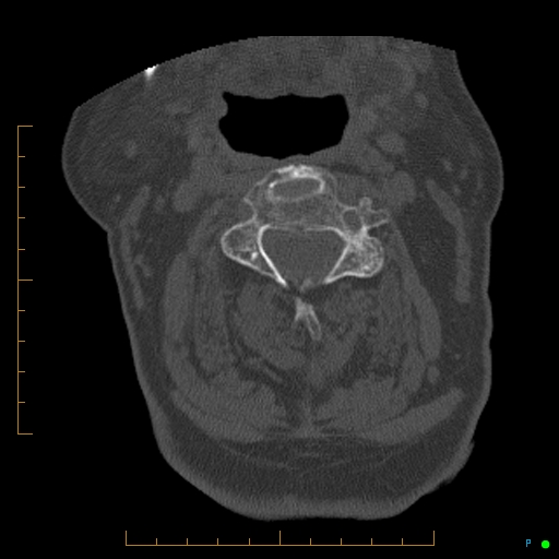 Cervical spine fracture - ankylosing spondylitis (Radiopaedia 76835-88706 Axial bone window 83).jpg