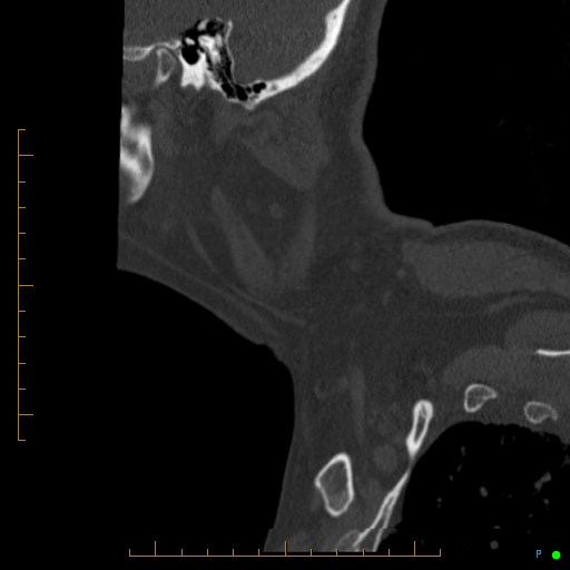 Cervical spine fracture - ankylosing spondylitis (Radiopaedia 76835-88706 Sagittal bone window 110).jpg