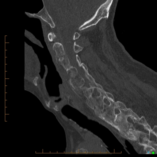 Cervical spine fracture - ankylosing spondylitis (Radiopaedia 76835-88706 Sagittal bone window 68).jpg