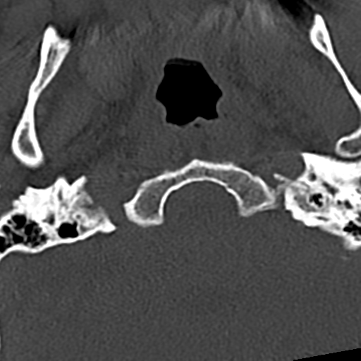 Cervical spine fracture - chalk stick (Radiopaedia 39116-41323 Axial bone window 2).png