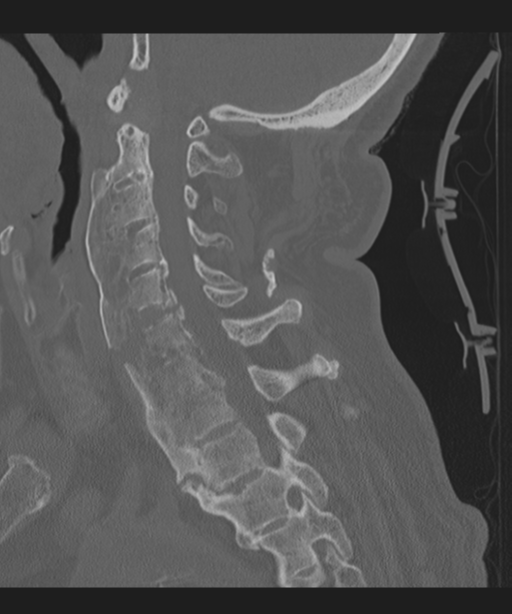 Cervical spine fracture in the setting of ankylosis (Radiopaedia 37038-38715 Sagittal bone window 37).png