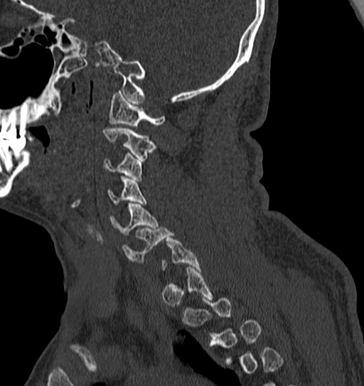 Cervical spine trauma with tear drop fracture and perched facet joint (Radiopaedia 53989-60127 Sagittal bone window 125).jpg