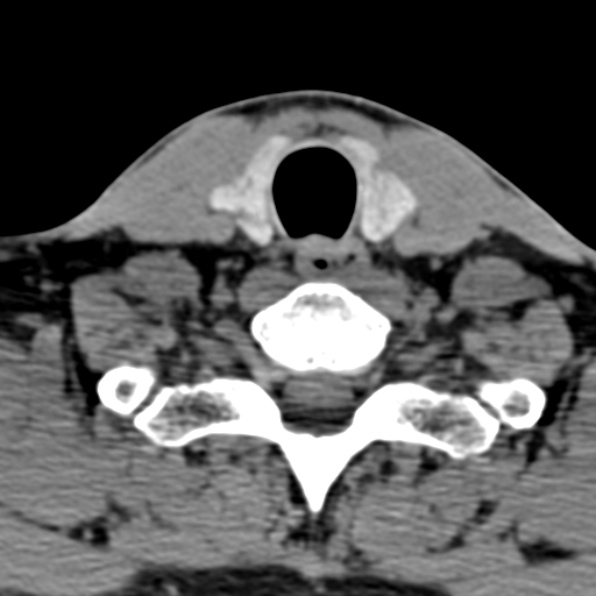 Cervical spondylodiscitis (Radiopaedia 28057-29489 Axial non-contrast 64).jpg