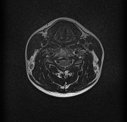 File:Cervical spondylodiscitis and calvarial hemangioma (Radiopaedia 64317-73104 Axial T2 10).jpg