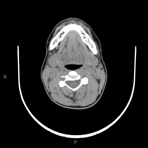 File:Cervical thymic cyst (Radiopaedia 88632-105335 Axial non-contrast 73).jpg