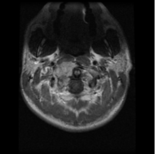 File:Cervical vertebrae metastasis (Radiopaedia 78814-91667 Axial T1 C+ 25).png