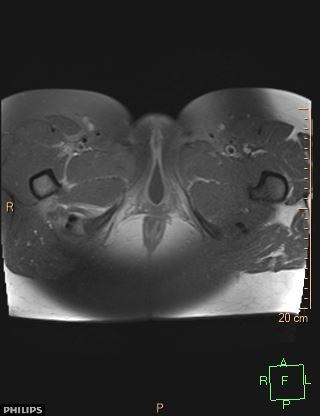 File:Cesarian scar endometriosis (Radiopaedia 68495-78066 Axial T1 C+ fat sat 29).jpg