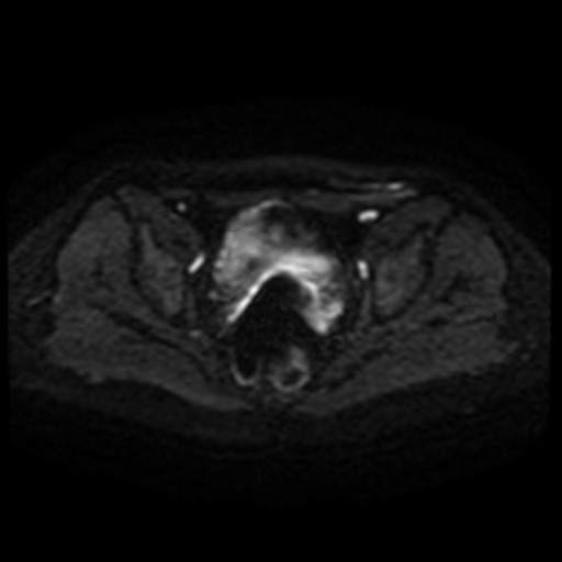 Cesarian section scar endometriosis (Radiopaedia 66520-75799 Axial DWI 39).jpg