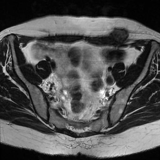 File:Cesarian section scar endometriosis (Radiopaedia 66520-75799 Axial T2 6).jpg