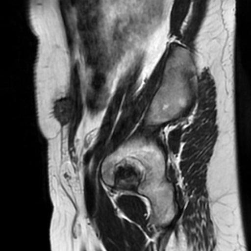 File:Cesarian section scar endometriosis (Radiopaedia 66520-75799 Sagittal T2 14).jpg