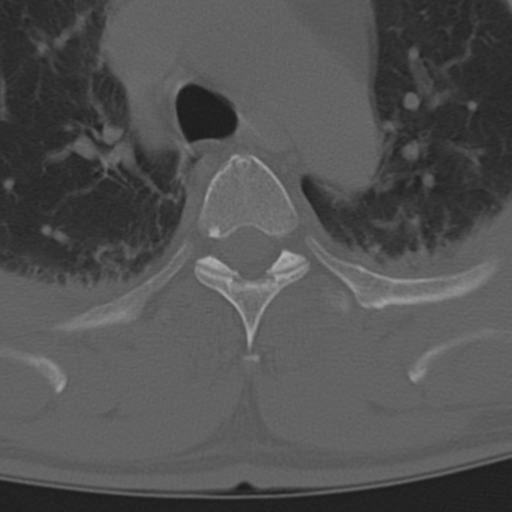 Chance fracture (Radiopaedia 33854-35020 Axial bone window 26).png