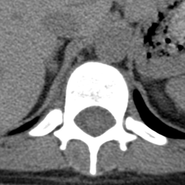 File:Chance fracture (Radiopaedia 36521-38081 Axial non-contrast 55).jpg
