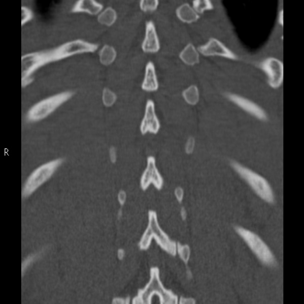 File:Chance fracture (Radiopaedia 36521-38081 Coronal bone window 54).jpg