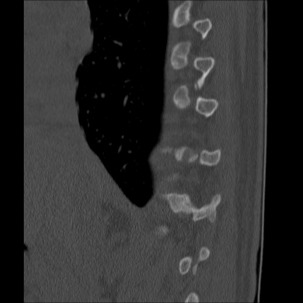 Chance fracture (Radiopaedia 36521-38081 Sagittal bone window 12).jpg