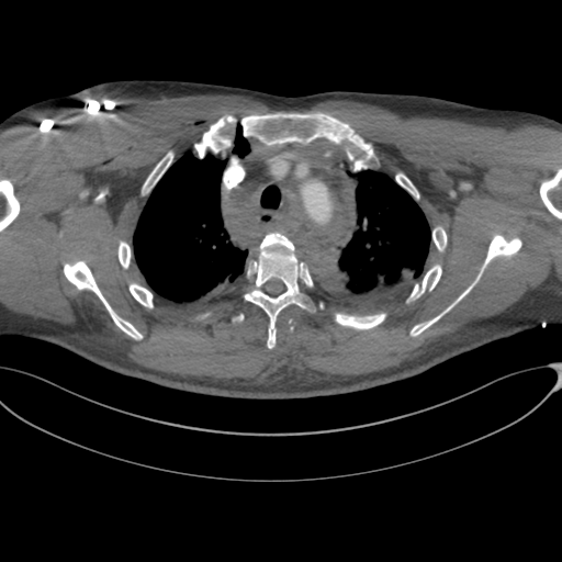 File:Chest multitrauma - aortic injury (Radiopaedia 34708-36147 A 71).png