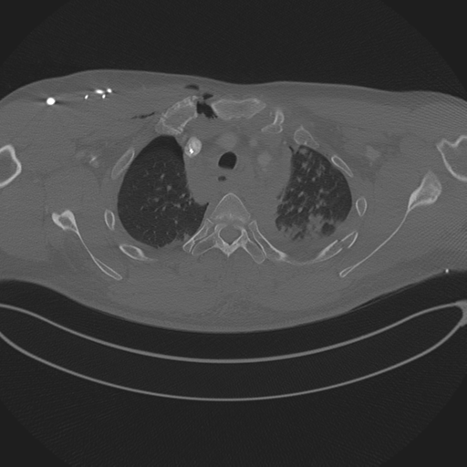Chest multitrauma - aortic injury (Radiopaedia 34708-36147 Axial bone window 63).png
