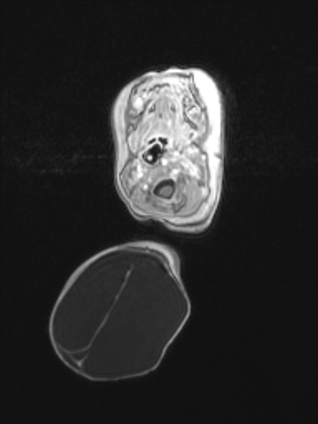 Chiari III malformation with occipital encephalocele (Radiopaedia 79446-92559 Axial T1 C+ mpr 22).jpg