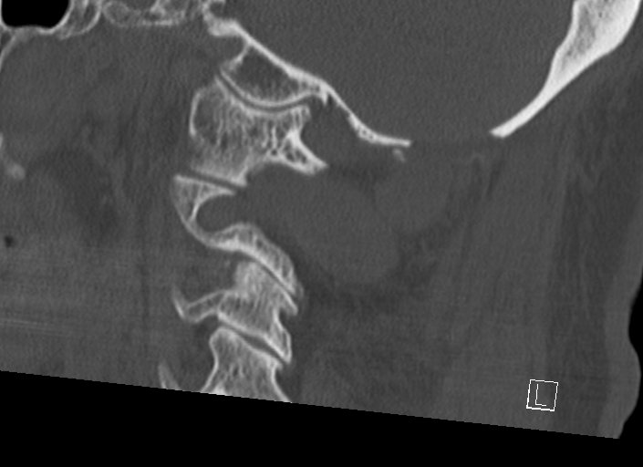 Chiari I malformation with a symptomatic syrinx of the posterolateral medulla oblongata (Radiopaedia 42573-45707 A 41).jpg