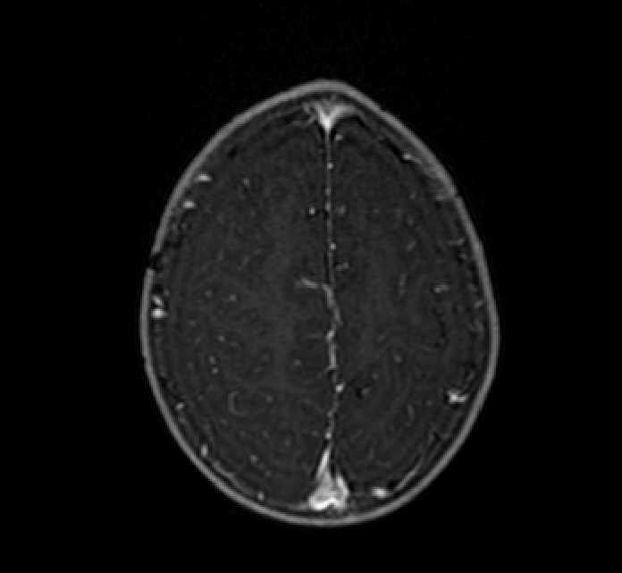 Chiasmatic-hypothalamic glioma (Radiopaedia 90079-107252 Axial T1 C+ 75).jpg