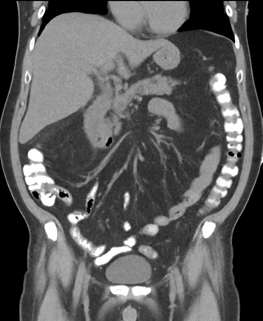 Cholecystitis with focal perforation and hepatic abscess (Radiopaedia 37189-38945 Coronal non-contrast 25).png