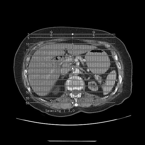 File:Cholecystoduodenal fistula (Radiopaedia 35234-36772 B 1).jpg