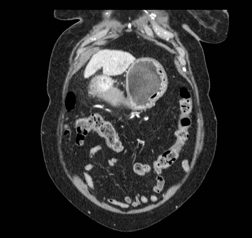 Cholecystoduodenal fistula (Radiopaedia 48959-54022 B 44).jpg