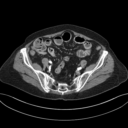 Cholecystoduodenal fistula due to calculous cholecystitis with gallstone migration (Radiopaedia 86875-103077 A 55).jpg