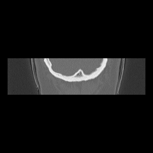 Cholesteatoma (Radiopaedia 84946-100455 Coronal bone window 159).jpg