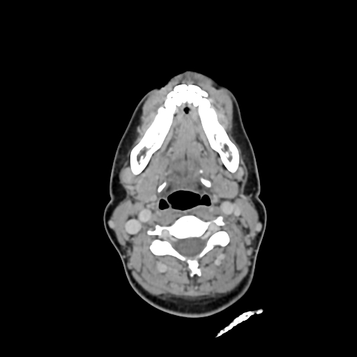 File:Chondroblastic osteosarcoma (Radiopaedia 67363-76741 Axial with contrast 18).jpg